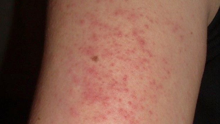 STRESS RASH How To Identify And Treat Rashes Caused By Stress