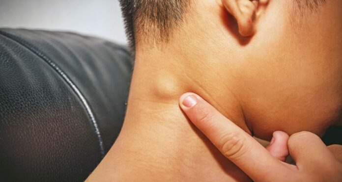 LYMPH NODES What Are The Swollen Lymph Nodes And Its Causes