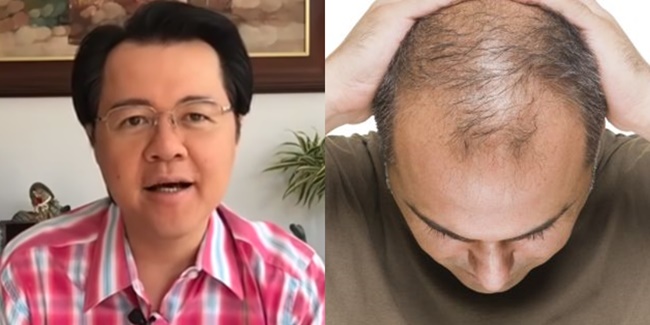 Hair Loss by Dr Willie Ong