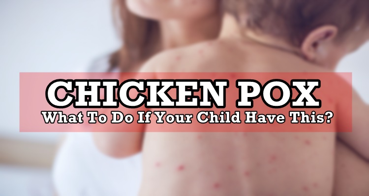 CHICKEN POX (Bulutong-Tubig): What To Do If Your Child Have This?