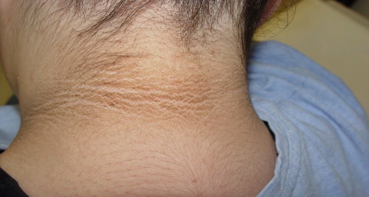 acanthosis-nigricans-what-you-need-to-know-about-this-condition