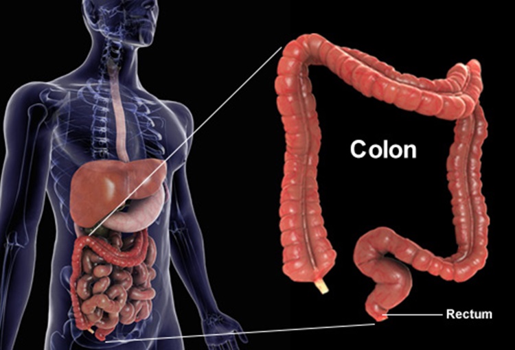 Colon Cancer Signs