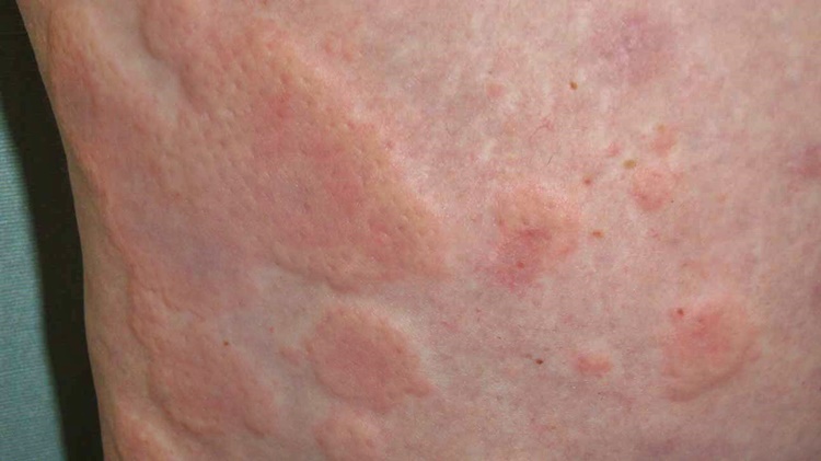 STRESS RASH How To Identify And Treat Rashes Caused By Stress