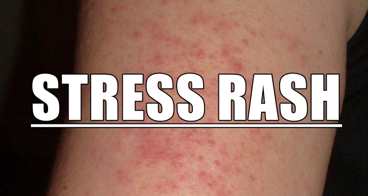 STRESS RASH How To Identify And Treat Rashes Caused By Stress