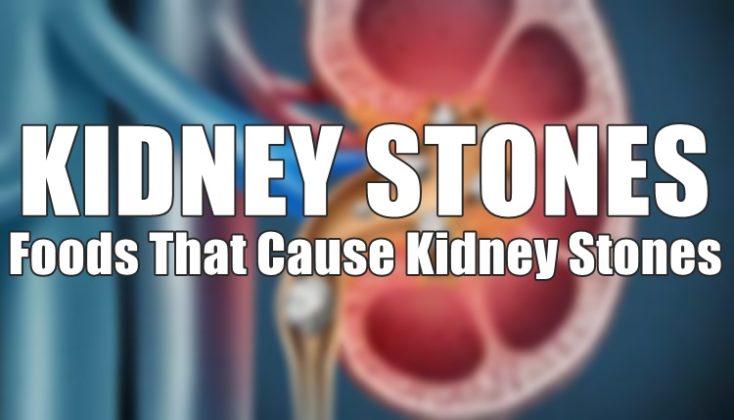 Kidney Stones - List Of Some Foods That Causes Kidney Stones