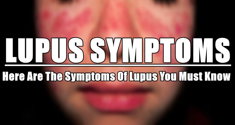 Lupus Symptoms