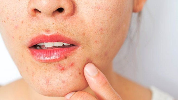 Skincare Tips, Acne