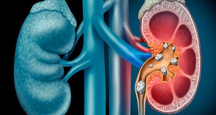 Kidney Stones: Other Body Parts Stones May Form Apart From Kidney