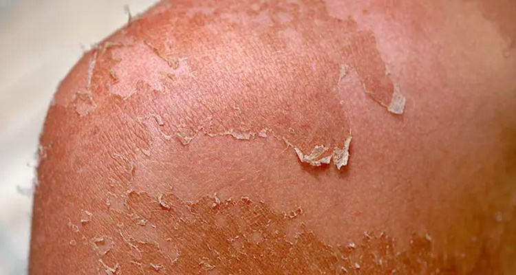 Causes Of Peeling Skin