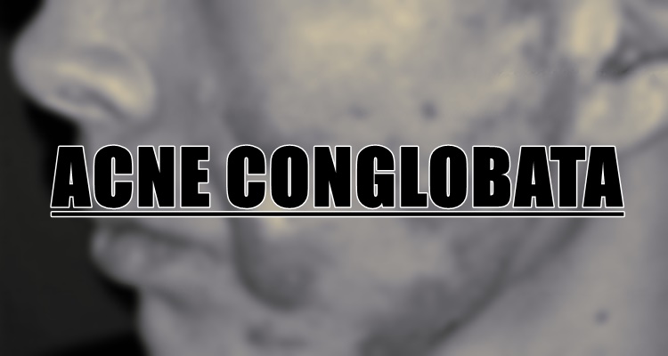 Acne Conglobata