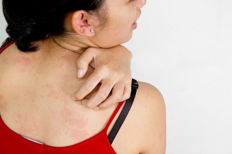 Itchy Skin as Symptom for Cancer