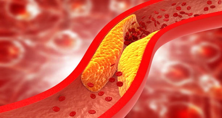 Coronary Artery Disease - Indications and Signs Of Blocked Arteries