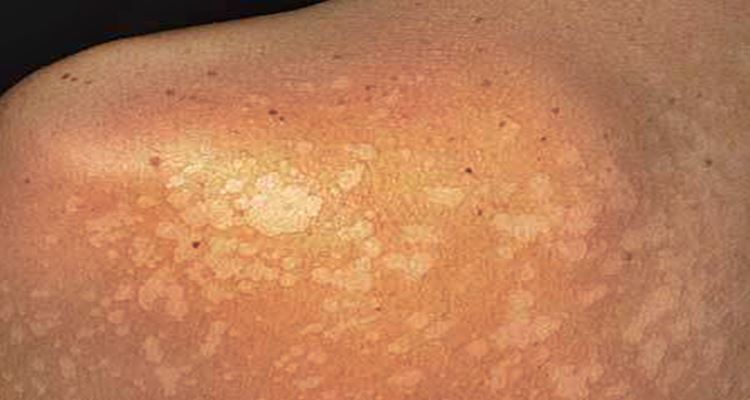 Pityriasis Alba - Causes and Symptoms Of This Skin Disorder