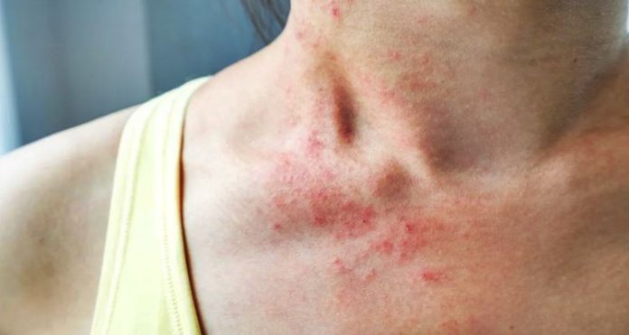 Skin Allergy Symptoms