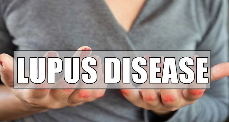 Lupus Disease