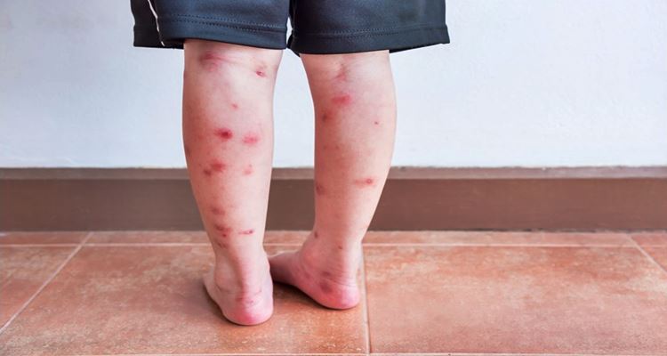 bed-bug-bites-treatment-and-prevention