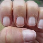 Signs of Health Problems in Nails