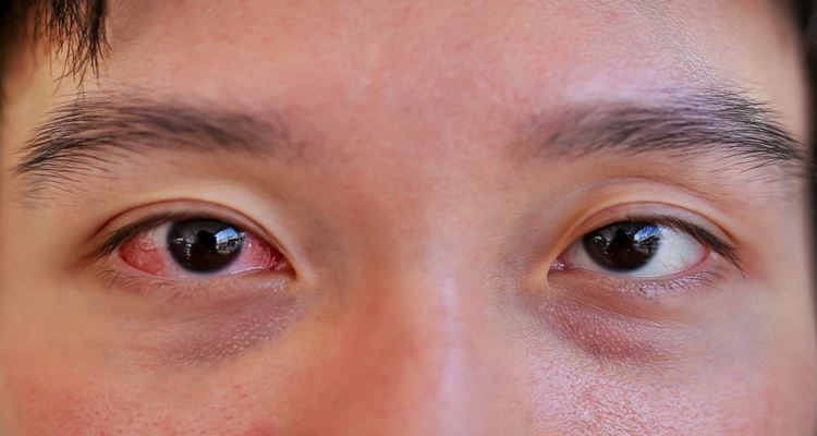 Sore Eyes Symptoms Causes And Treatment