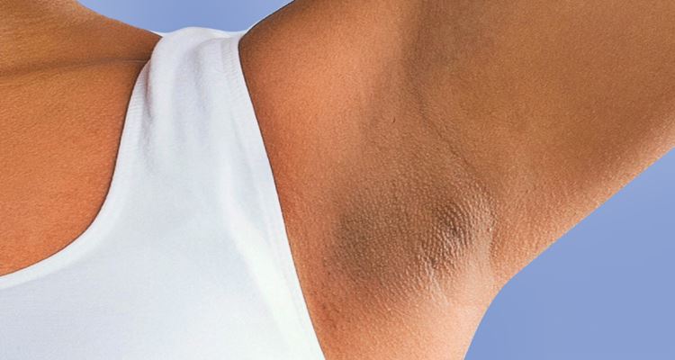 top-7-home-remedies-for-armpit-rash