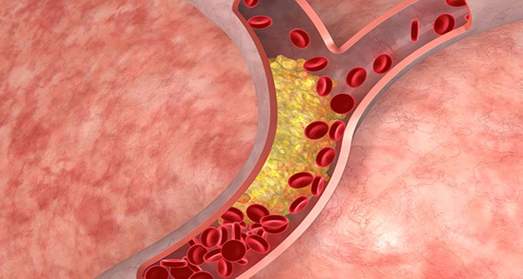 High Cholesterol Risk Factors And Complications