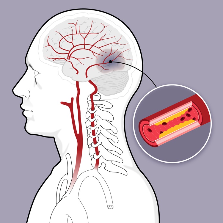 Stroke Prevention - What can you do? - Health Tips